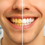yellow teeth treatment home remedies